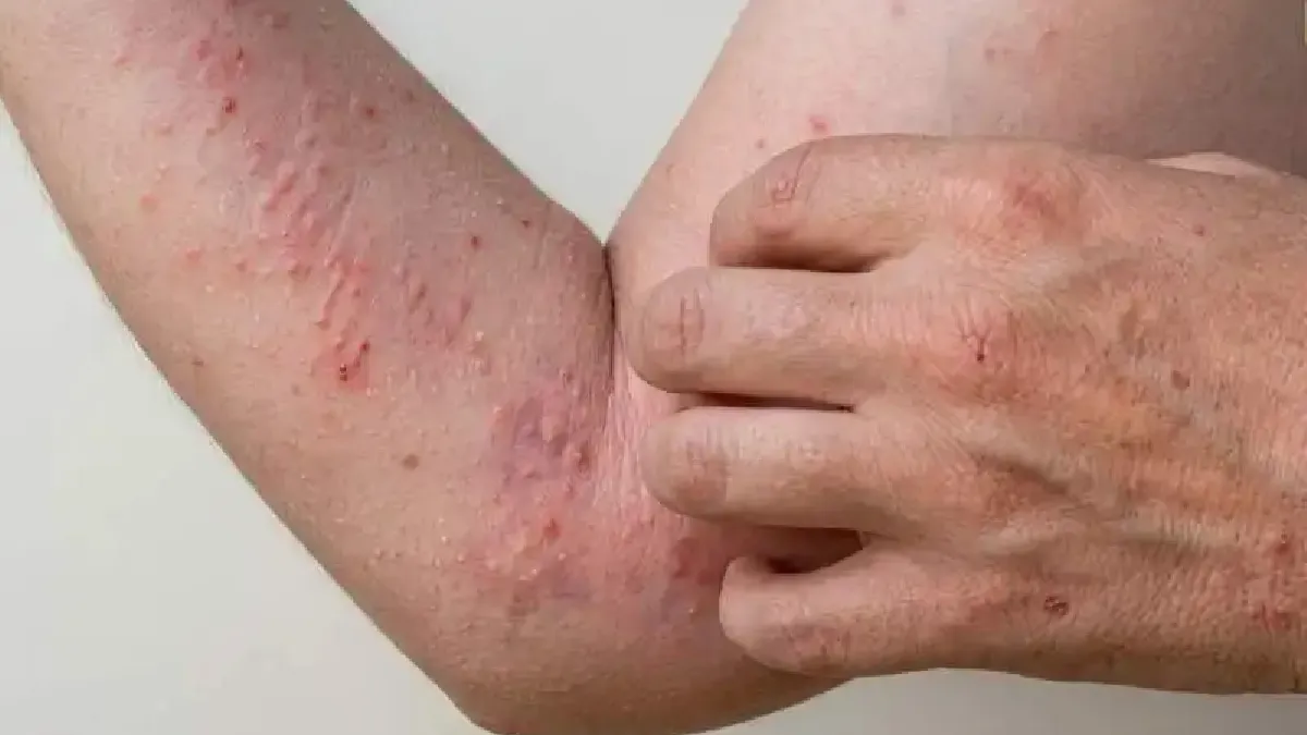 chikungunya-jujuy-foto-ilustrativa