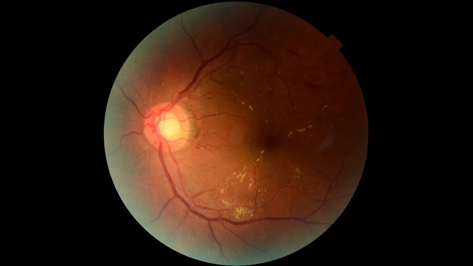 Retinar Retinar